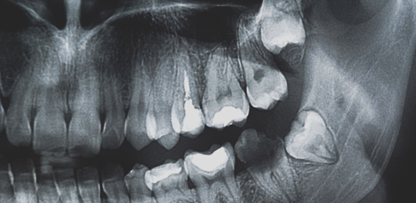 Wisdom Teeth Removal X Rays