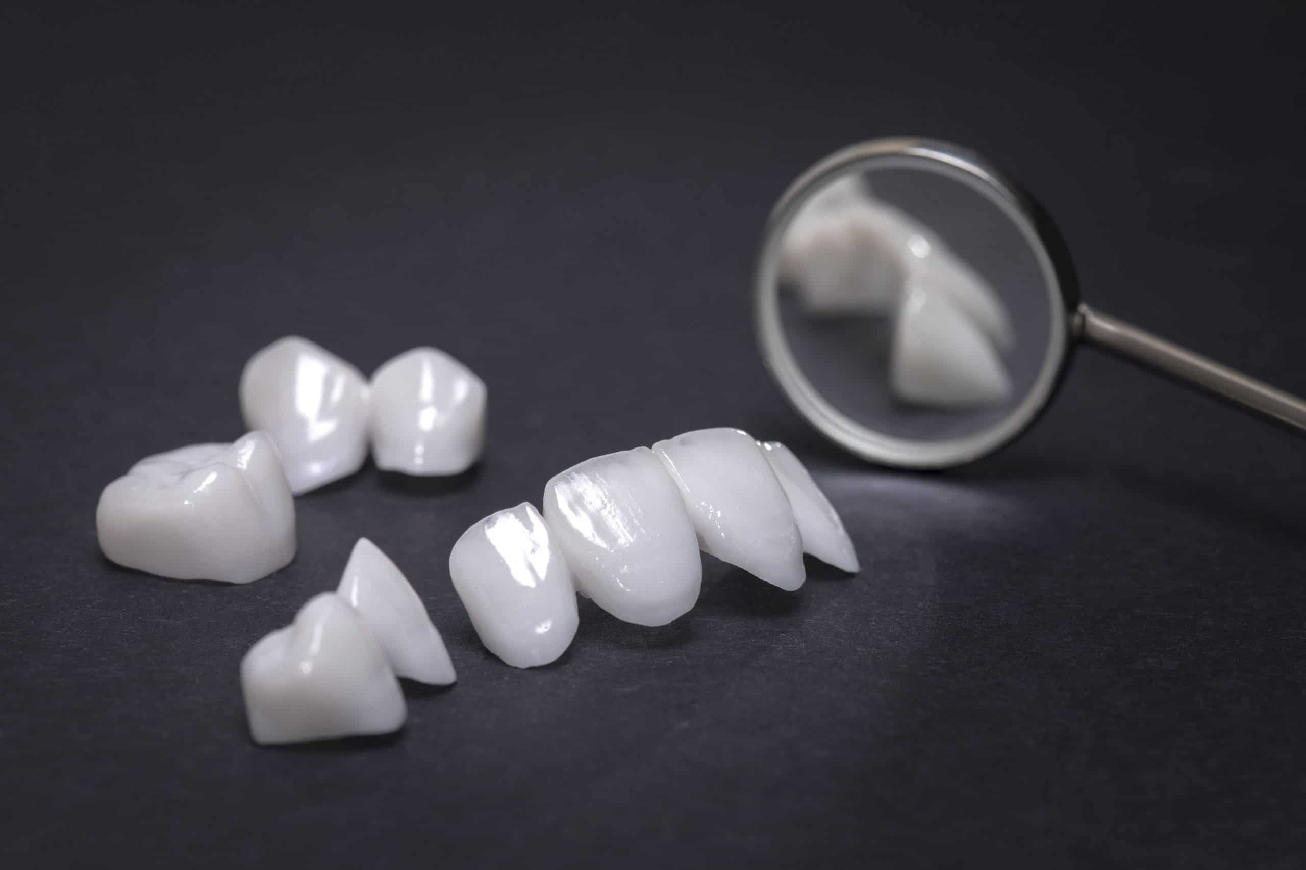 Dental Crowns and Bridges: The Ultimate Guide