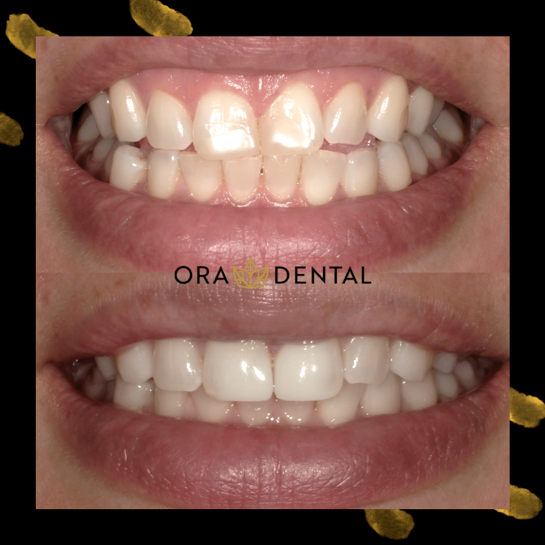 Dental correction before and after images