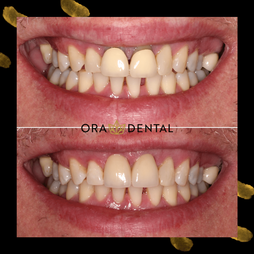 Orthodontic treatment progress photos