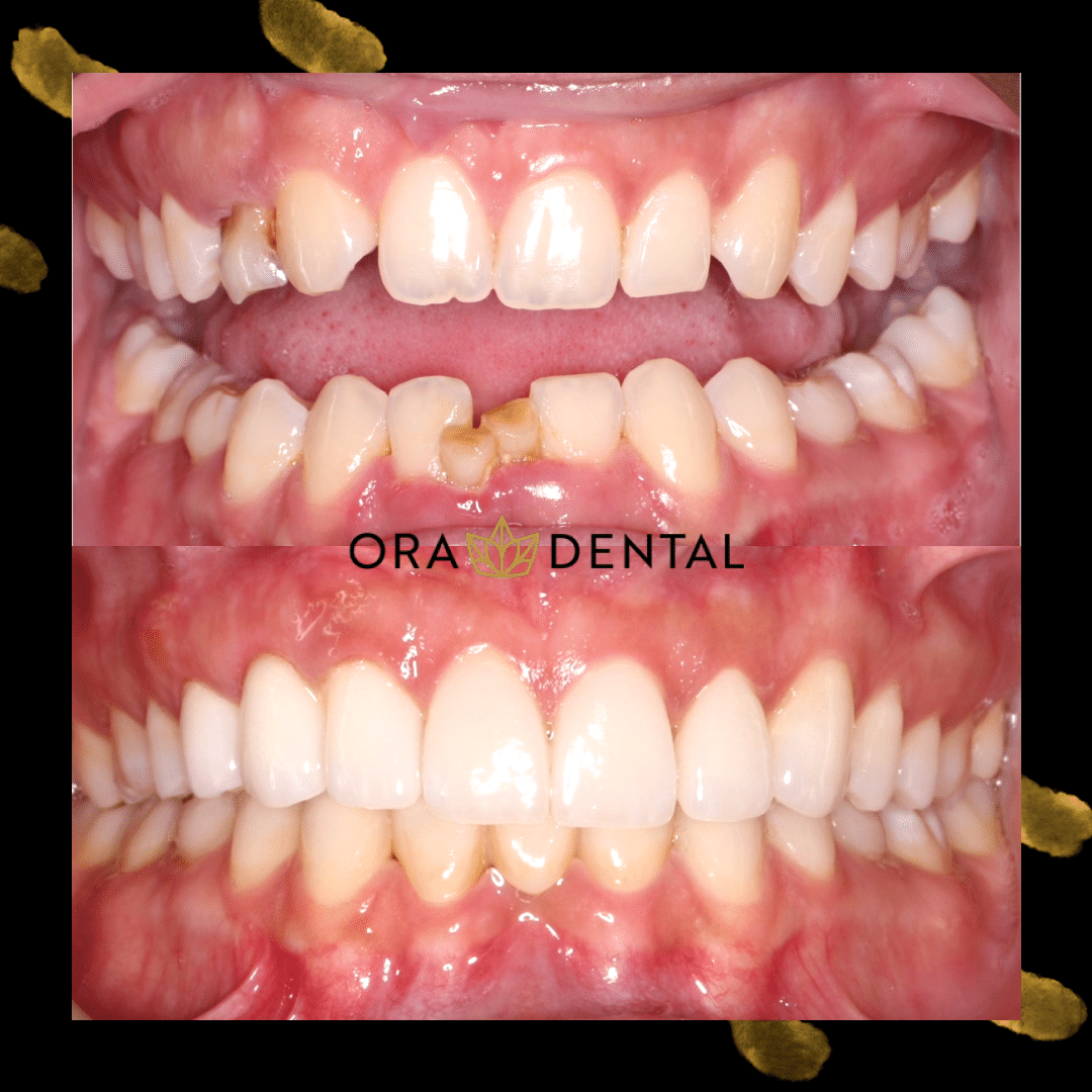 Ora dental Before And After Cosmetic Dental Procedure Pictures
