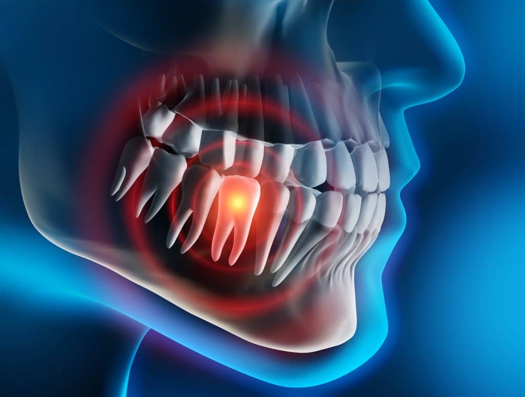 Wisdom teeth typically cause pain because they are impacted